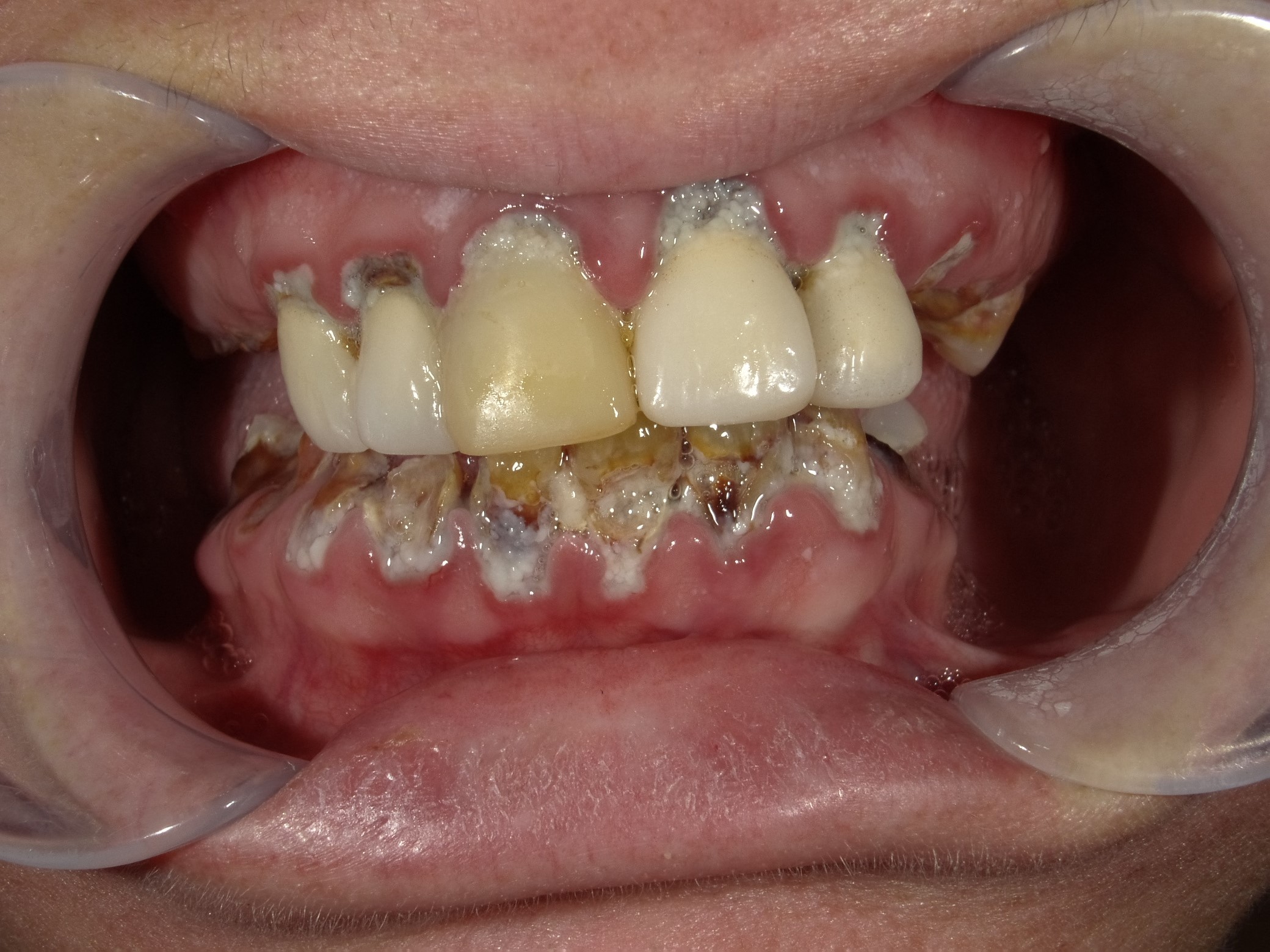 dental implant port st luciereviews'