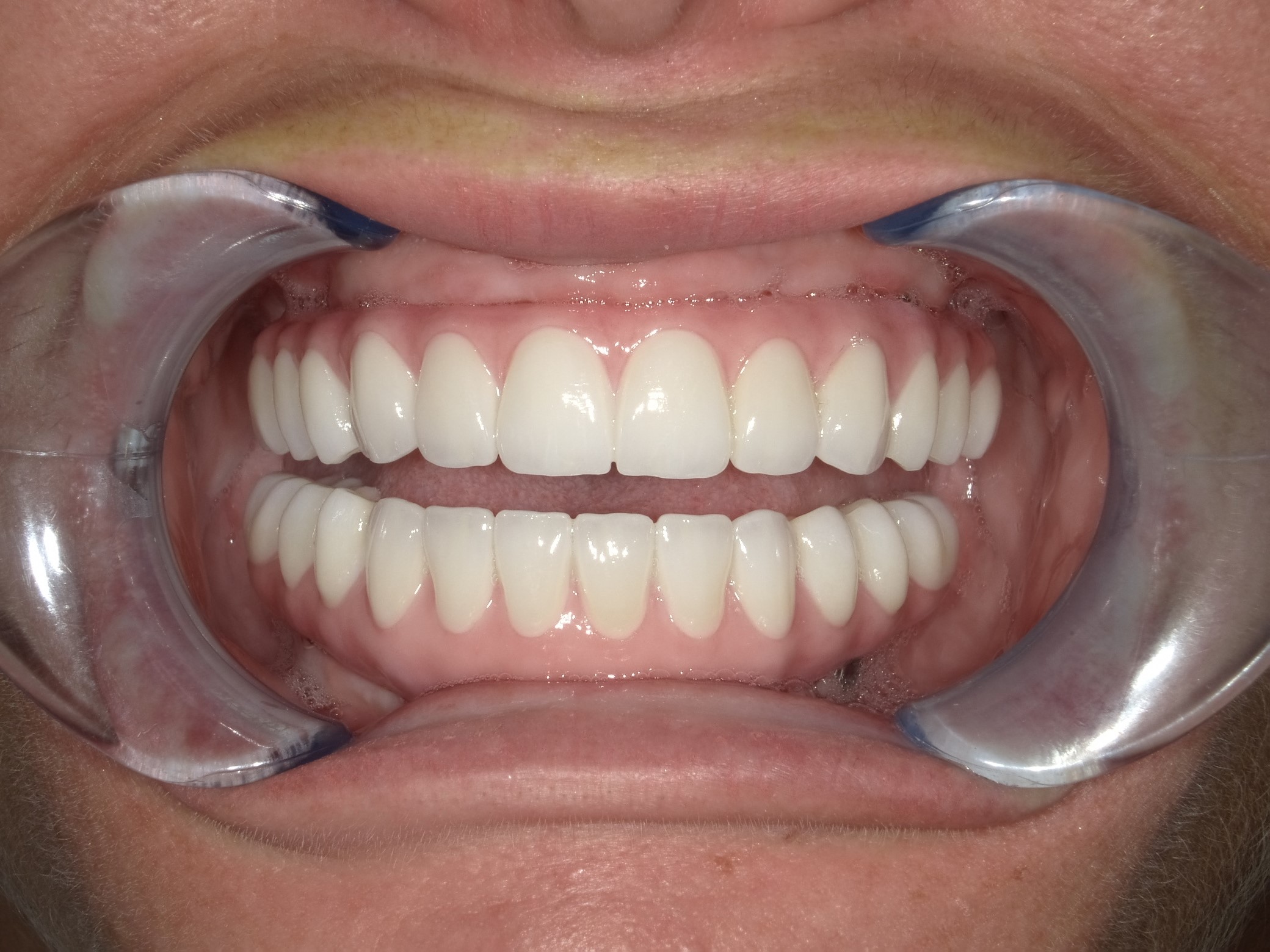After cosmetic dentist port st lucie dental implants Implant