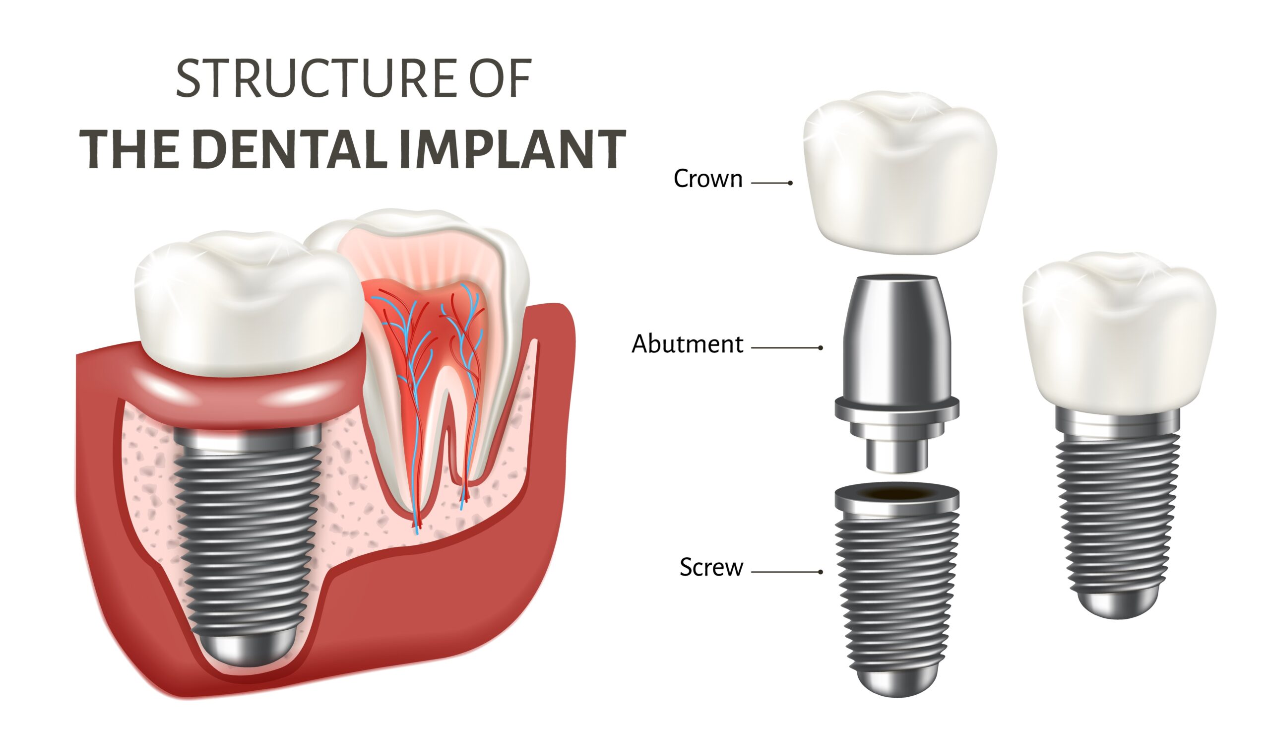 Types of dental implants port st lucie