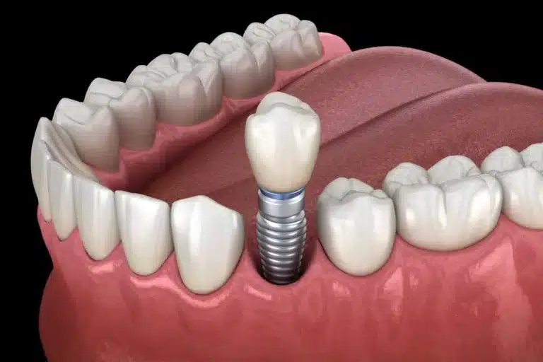 Dental Implant